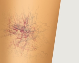 Leg showing spider veins only