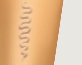 ფეხზე ჩანს ვენური ქსელები