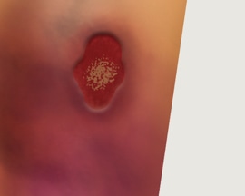 ფეხზე აღინიშნება ღია ვენური წყლული