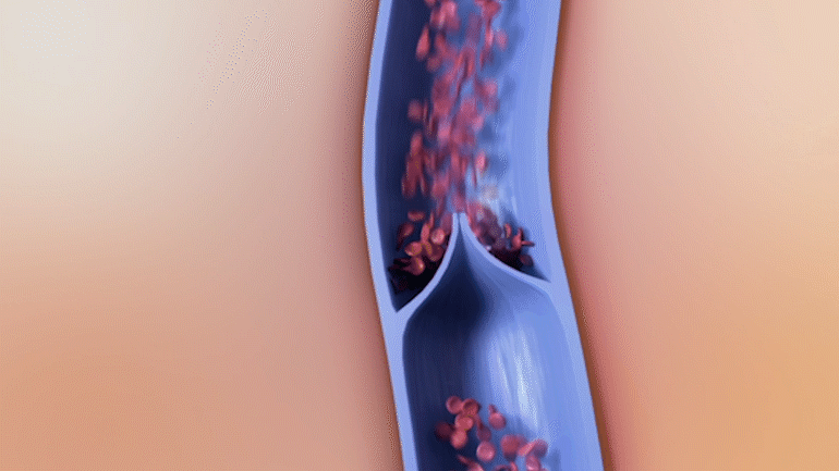 ჯანმრთელი ვენის ილუსტრაცია, რომელიც აჩვენებს, რომ ნორმალური ვენის კომპრესია ხელს უწყობს სისხლის მიდინებას გულისკენ.