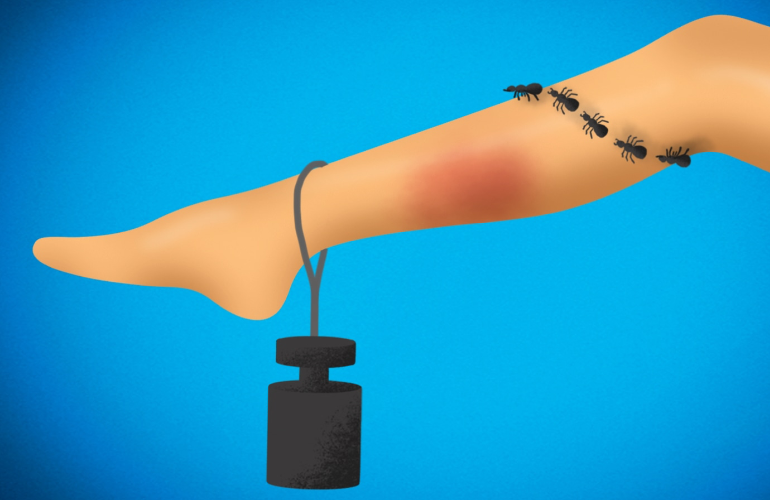 ფეხების სიმძიმე ვარიკოზული ვენებით და სიწითლით