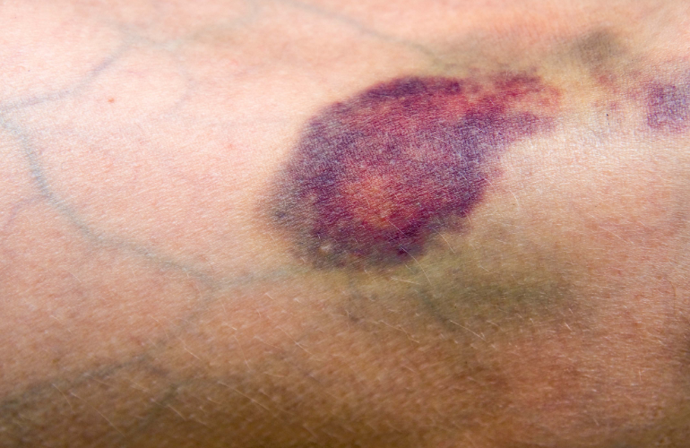 კანქვეშა ჰემატომა ახლოდან, წითელი და იისფერი სისხლჩაქცევებით.