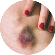 სისხლჩაქცევები და ჰემატომები