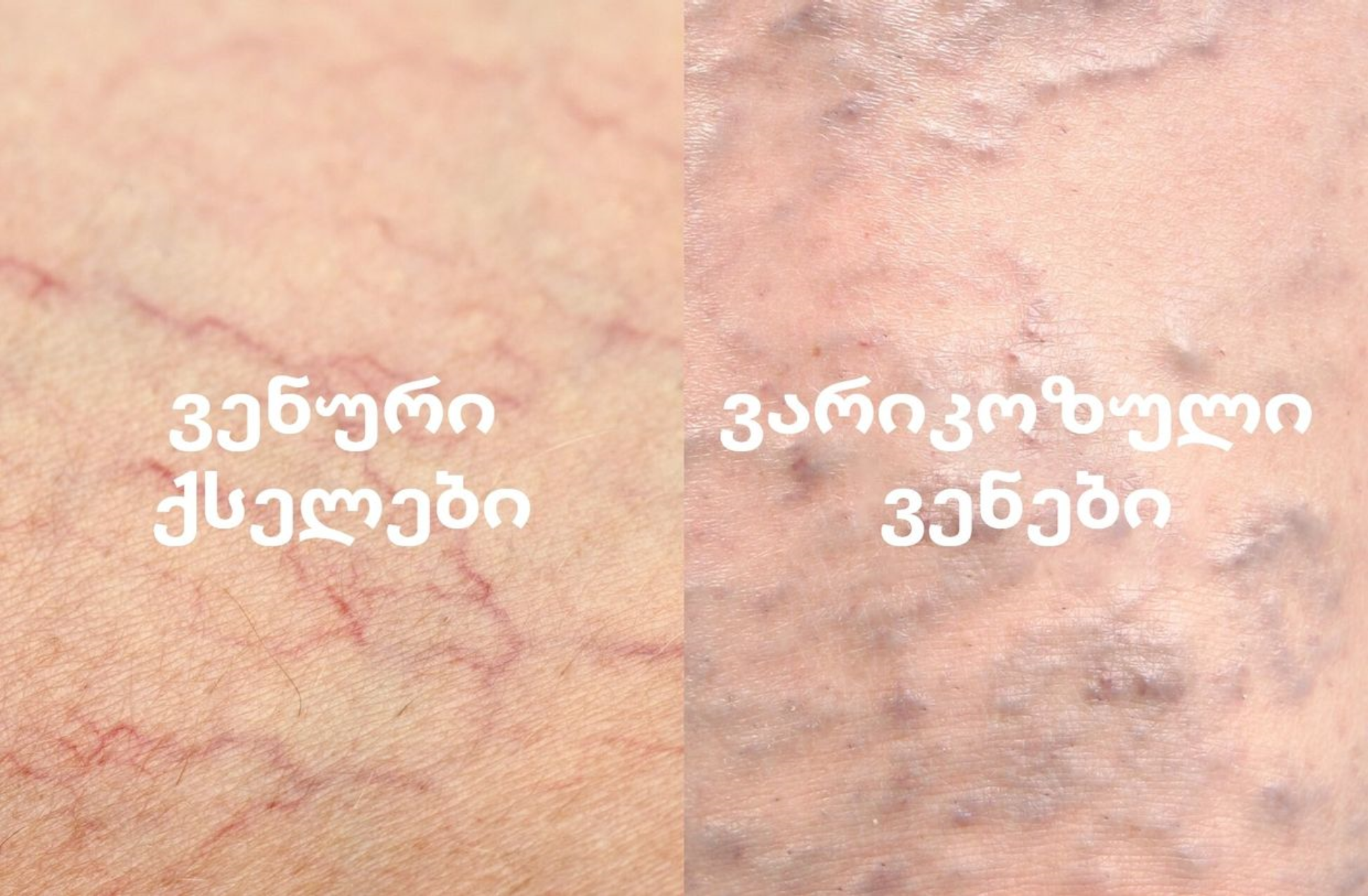 ობობას ქსელივით ვენების და ვარიკოზული ვენების შედარების ფოტო